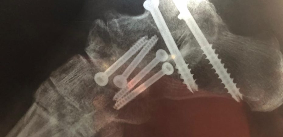 Pilar Cisneros Walk incluye accidentes de tráfico, dos operaciones y cinco pines en el tobillo

 – Reporte Tico