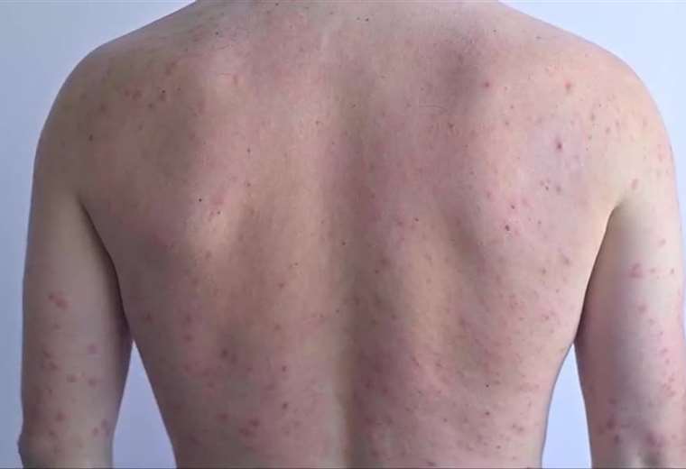 Los médicos advierten: un paciente con sarampión puede infectar hasta 18 personas

 – Reporte Tico